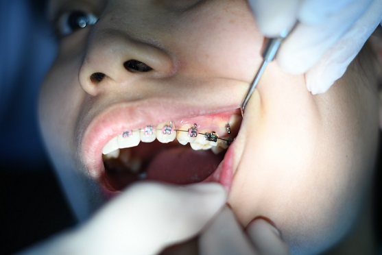 damon sistem proteze za zube