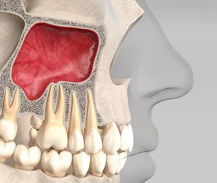 Sinus lift