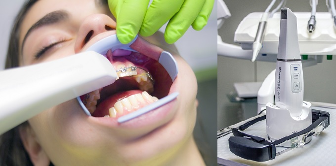Prednosti skeniranja zuba u odnosu na uzimanje otiska