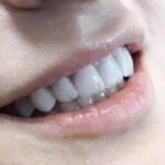 Karijes na prednjim zubima