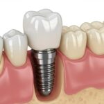 Implanti – kada se za njih odlučiti i zašto su bolje rešenje od mosta