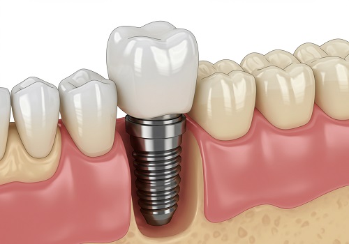 Implanti – kada se za njih odlučiti i zašto su bolje rešenje od mosta