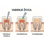 vađenje živca iz zuba