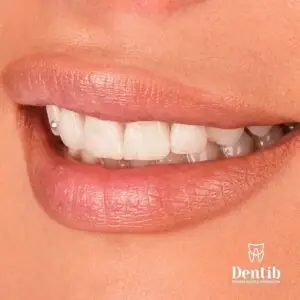 Protetski materijal: kako izabrati pravi za vaše zube