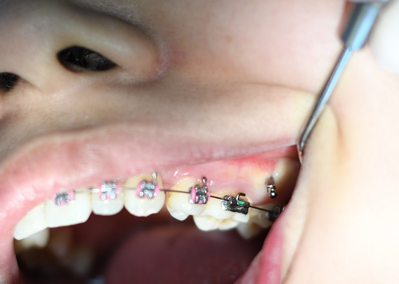 Estetska fiksna proteza sa roze gumicama i metalnim breketima na gornjoj vilici pacijenta u stomatološkoj ordinaciji DENTIB, Arilje.