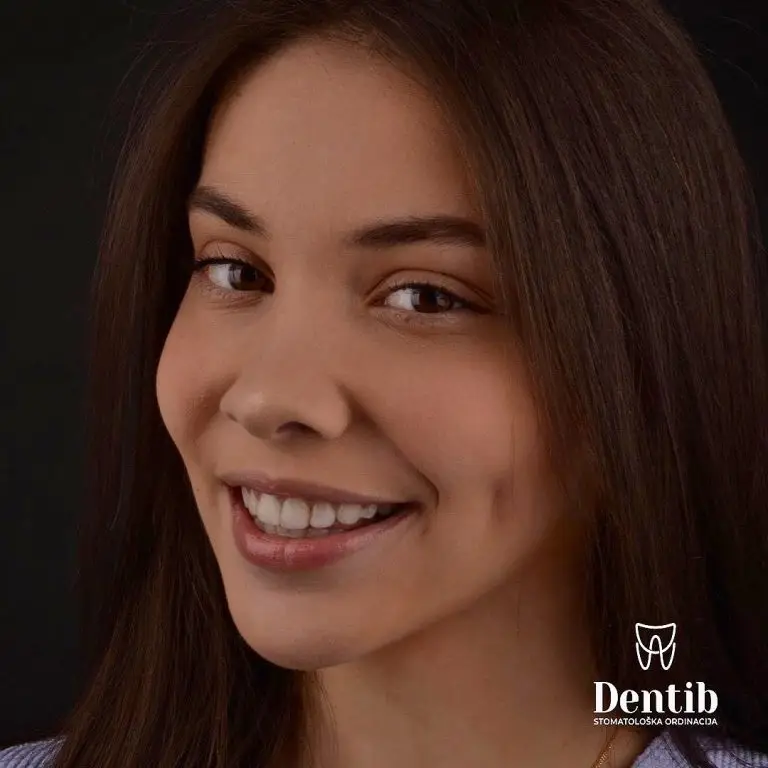 Mlada pacijentkinja sa prirodnim i zdravim osmehom nakon estetske transformacije zuba u klinici Dentib kod dr Ljubice Stefanović u Arilju. Vrhunska stomatologija za pacijente iz Srbije, dijaspore i celog Zlatiborskog okruga (Užice, Požega, Ivanjica, Čačak, Bajina Bašta).