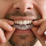 Pacijent postavlja prozirni stabilizacioni splint protiv škripanja zuba u ordinaciji Dentib Arilje