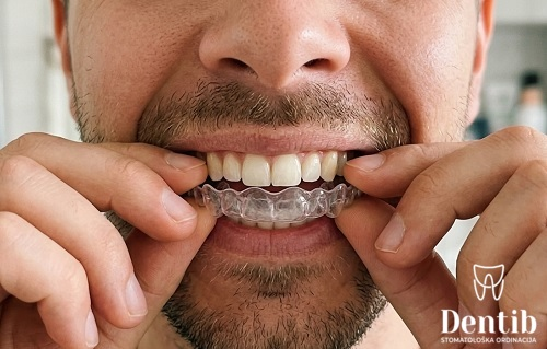 Pacijent postavlja prozirni stabilizacioni splint protiv škripanja zuba u ordinaciji Dentib Arilje