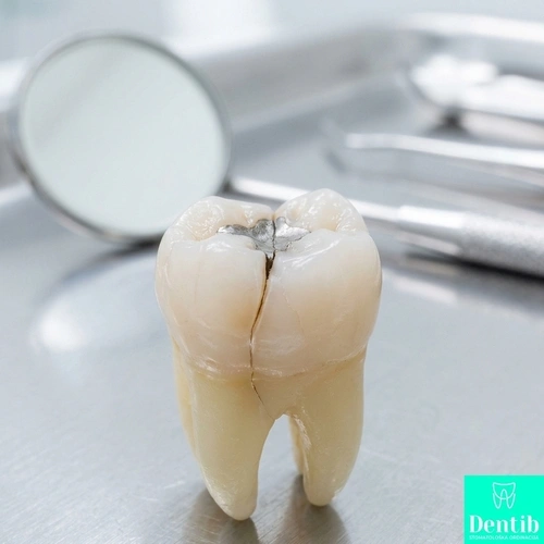 Pukotine u zubu Dentib Arilje