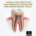 Nekroza zuba (Mrtav zub) – Kako prepoznati zub koji više nema prokrvljenost i živac Dr Ljubica Stefanovic Dentib Arilje