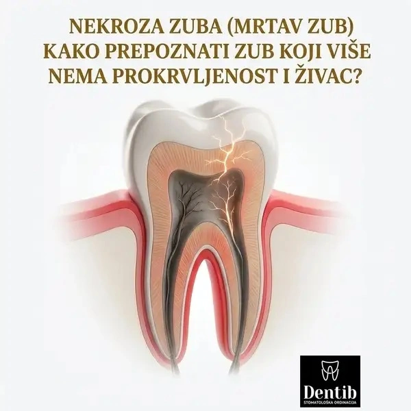 Nekroza zuba (Mrtav zub) – Kako prepoznati zub koji više nema prokrvljenost i živac Dr Ljubica Stefanovic Dentib Arilje