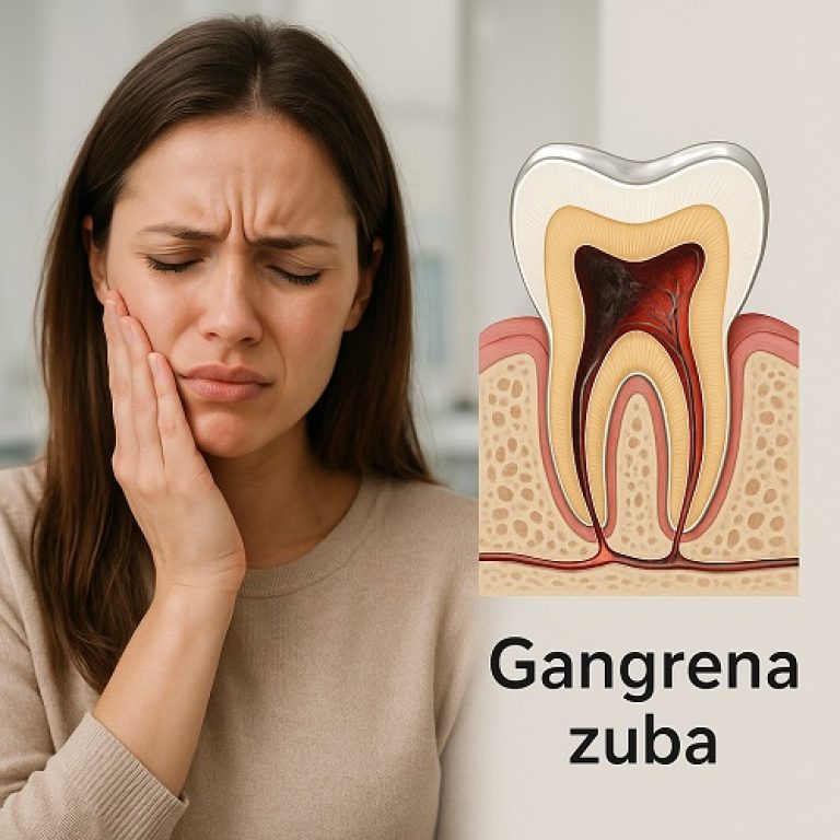Gangrena zuba i lečenje