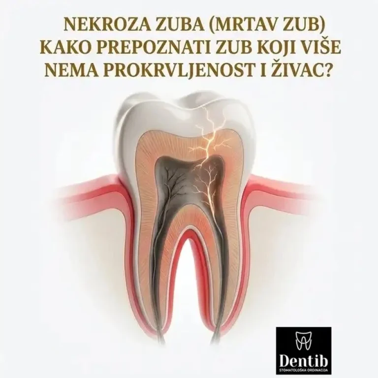 Nekroza zuba (Mrtav zub) – Kako prepoznati zub koji više nema prokrvljenost i živac Dr Ljubica Stefanovic Dentib Arilje