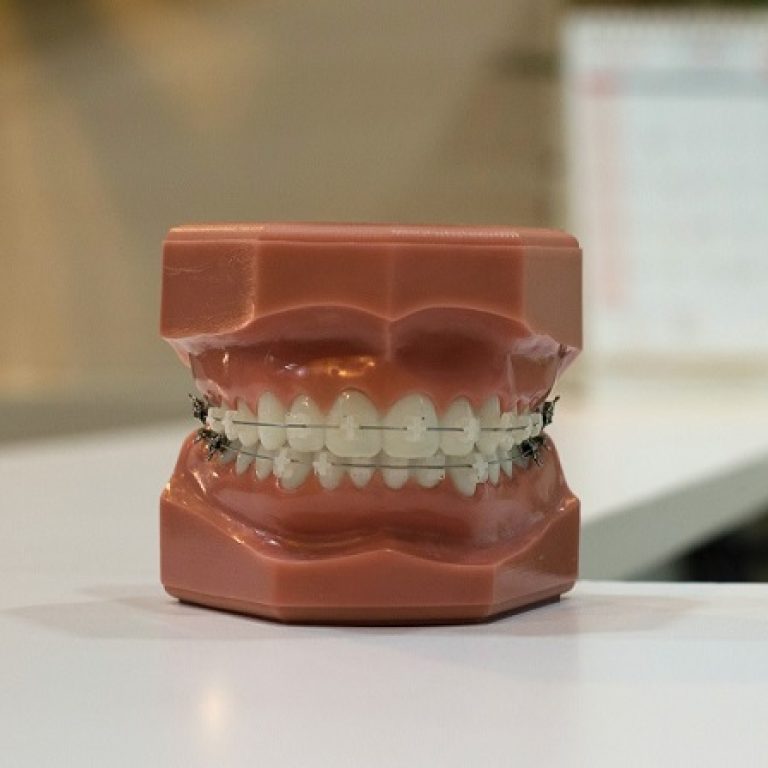 Ortodontska terapija fiksnim aparatom - Koliko traje