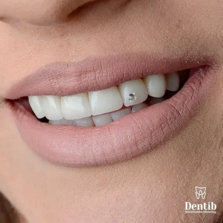 Nakit za zube: Klinički osvrt na estetske trendove. Dentib Arilje. Dr. Stefanović