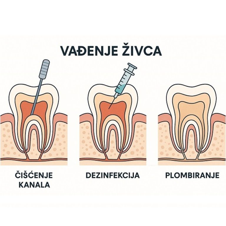 vađenje živca iz zuba