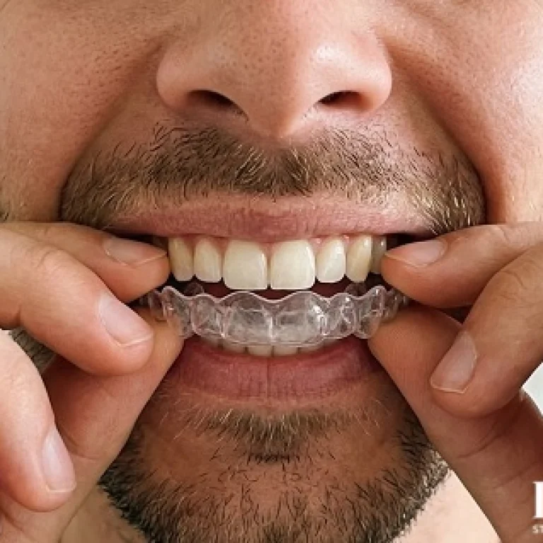 Pacijent postavlja prozirni stabilizacioni splint protiv škripanja zuba u ordinaciji Dentib Arilje